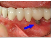 Biến chứng Implant