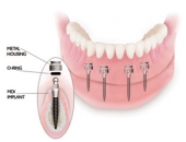 Implant là gì?