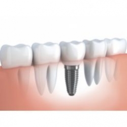 IMPLANT thay thế 1 răng