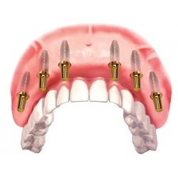 IMPLANT nâng đỡ cầu răng